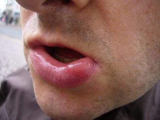 what to do if a wasp has bitten on the lip