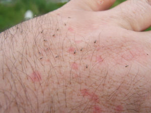 midge bite behandling hevelse fjerning