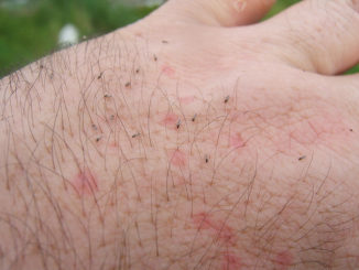 midge bite treatment swelling removal